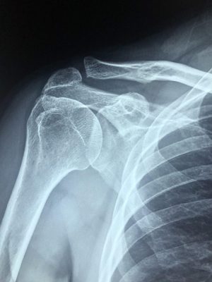 Zamrznjena rama izključitev patologije z rtg