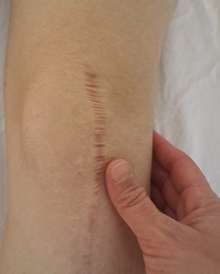 Ročna limfna drenaža po dr. Voddru LagunaMed