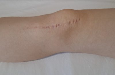 Ročna limfna drenaža po dr. Voddru LagunaMed